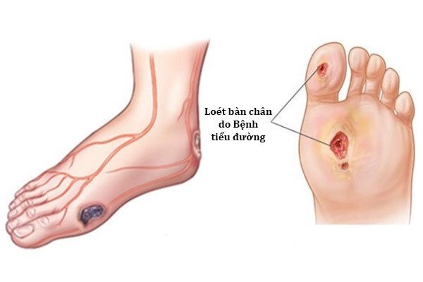 Những sai lầm thường gặp khiến bạn bị tiểu đường, căn bệnh làm nhiều người mất mạng