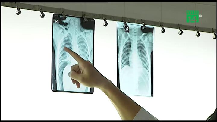 Bị bơm hơi vào hậu môn, bé trai Đồng Nai vỡ ruột già nguy kịch