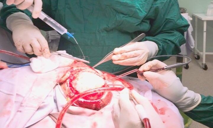 Bé trai 8 tháng tuổi xuất huyết não nguy kịch