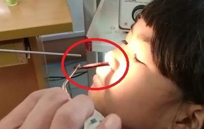 Uống nước suối, bé gái bị vắt khổng lồ ký sinh trong hốc mũi