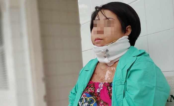 Thương tâm người phụ nữ trẻ bị bỏng nặng do chồng dùng xăng đốt