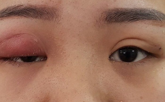 Video: Kim khâu gãy nằm trong mắt lúc nhấn mí làm đẹp