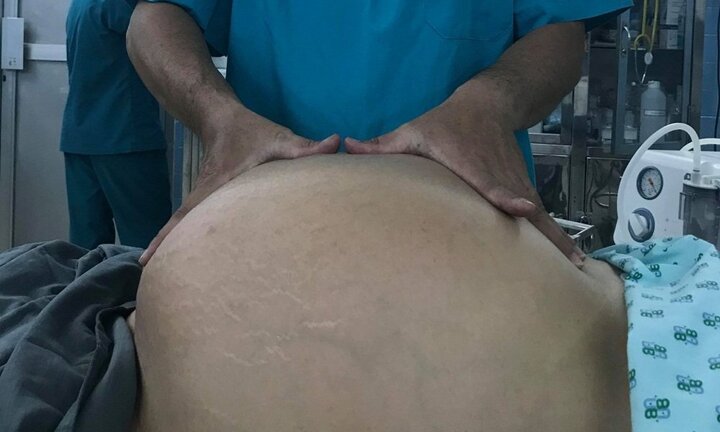 Mang khối u buồng trứng nặng 20kg, người phụ nữ 29 tuổi không thể đi lại