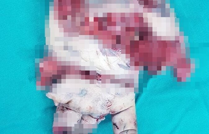 Bình gas phát nổ khi đang ăn lẩu, nam thanh niên nát bàn tay