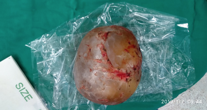 Bé trai 4 tháng tuổi phình to bụng vì mang 'thai trong thai' hiếm gặp