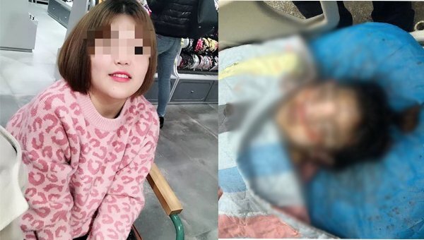 Cô gái 19 tuổi chết thương tâm sau phẫu thuật nâng mũi