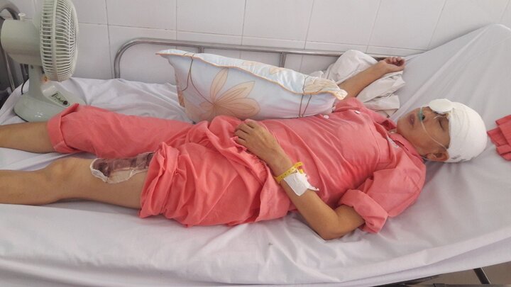 Ngã vào máy làm bún, người phụ nữ bị lóc toàn bộ da đầu