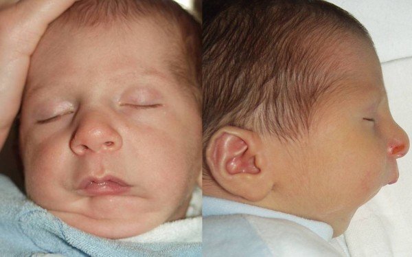 Căn bệnh nguy hiểm khiến trẻ có khuôn mặt hình mỏ chim