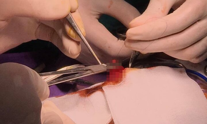 Hơn một giờ căng thẳng cứu bé trai hai ngày tuổi bị tắc ruột bẩm sinh