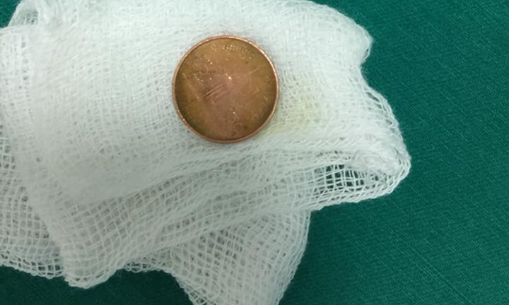 Đùa nghịch, bé gái 3 tuổi nuốt đồng xu vào họng