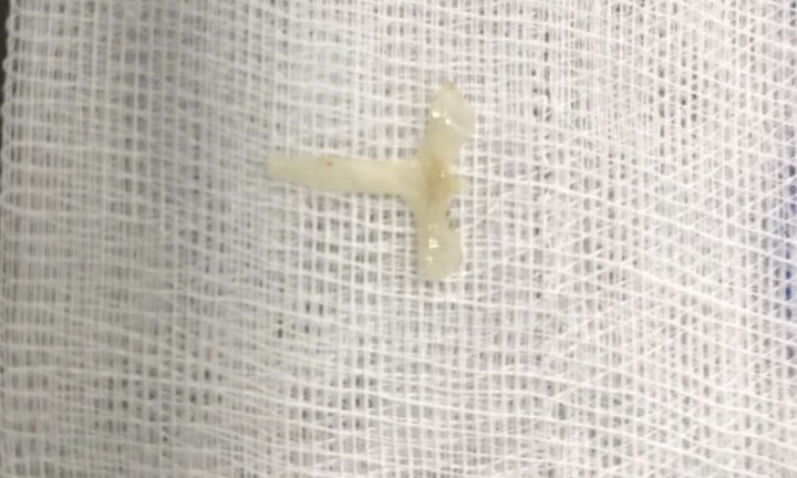 Xương ếch trong thực quản bé gái 10 tháng tuổi