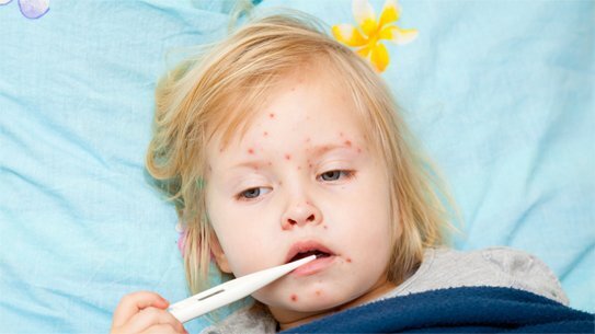 Bé gái 7 tuổi biến chứng viêm phổi nặng do bệnh sởi