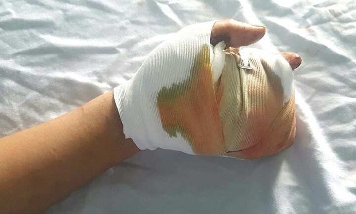 Nghịch pháo tự chế, thiếu niên 15 tuổi bị dập nát bàn tay