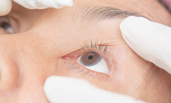 Mùa đông xuân, số người bị viêm kết mạc gia tăng