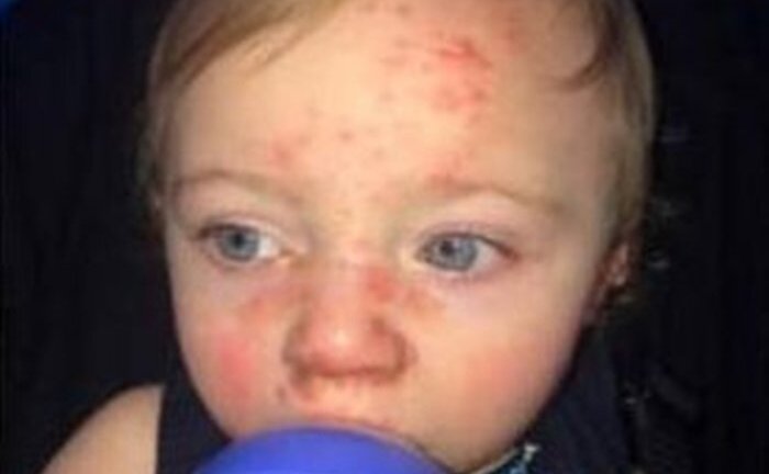 Thêm một bé trai 14 tháng tuổi suýt chết vì nụ hôn của người lớn
