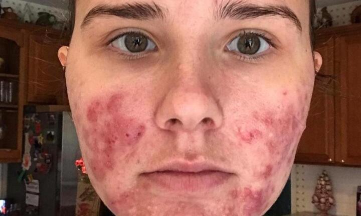 Mặt đầy mụn trứng cá, cô gái 23 tuổi không dám ra đường