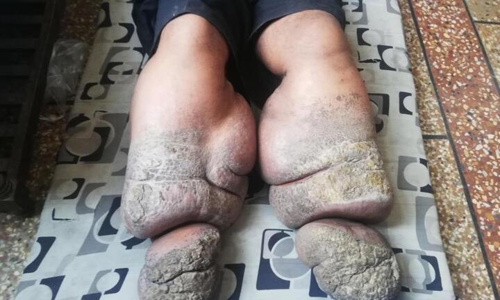 Căn bệnh lạ khiến người đàn ông có đôi chân khổng lồ như voi