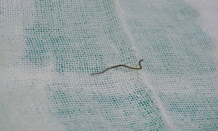 Cấp cứu nam thanh niên nuốt cả dây thép vào bụng khi ăn gà