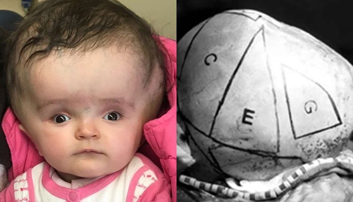 12 giờ căng thẳng phẫu thuật đầu to bất thường cho bé gái 2 tuổi