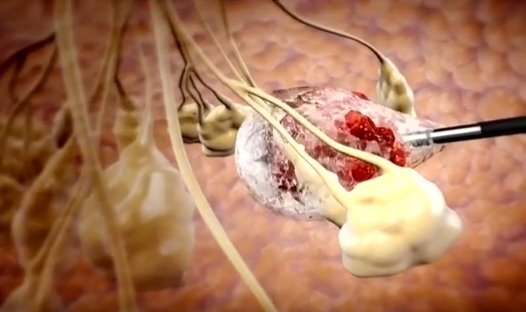 Điều trị ung thư vú không cần phẫu thuật, 'đóng băng' khối u là xong