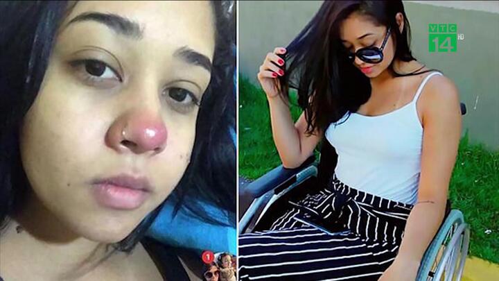 Xỏ khuyên mũi bị nhiễm trùng, thiếu nữ xinh đẹp liệt 2 chân