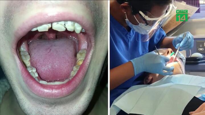 Nghiện nước tăng lực, chàng trai bị mục nát hàm răng