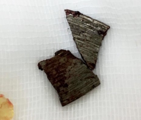 Người đàn ông 57 tuổi bị lưỡi cưa gạch bắn vào mắt