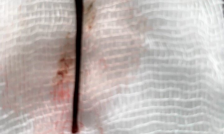 Gắp con đỉa còn sống dài 4cm ra khỏi mũi cô gái ở Quảng Nam