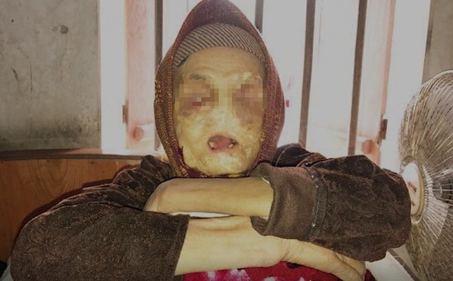 Căn bệnh quái ác ăn mòn khuôn mặt của cụ bà ở Thái Bình