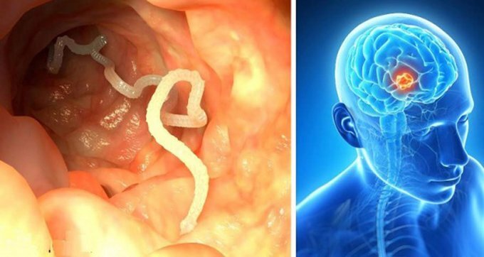 Cận cảnh ổ sán làm tổ trong não người đàn ông hay ăn tiết canh lợn