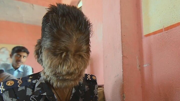 Clip: Cậu bé 'người sói', mắc bệnh hiếm khiến lông lá mọc khắp mặt