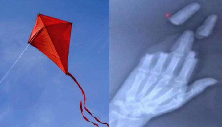 Người đàn ông mất 3 ngón tay vì thả diều