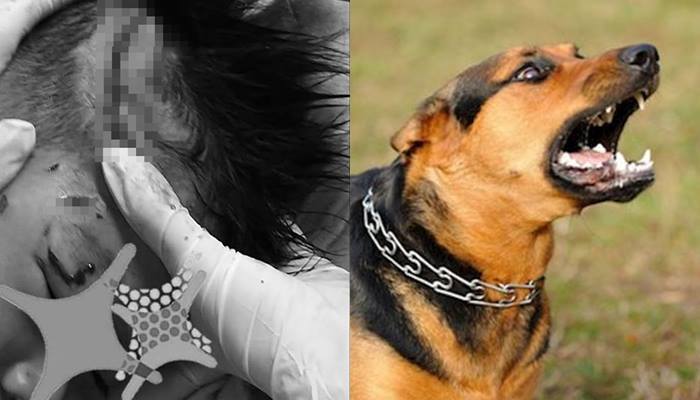 Bé 4 tuổi ở Hà Tĩnh bị chó cắn lóc da đầu, rách mặt