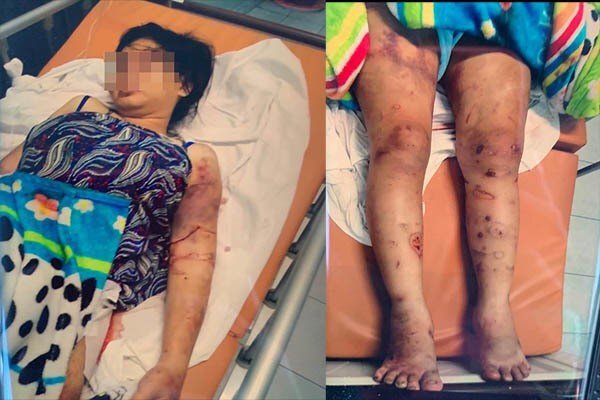 Cô gái bị tra tấn đến sảy thai: 'Chúng dùng keo nấu chảy nhỏ vào tay em'