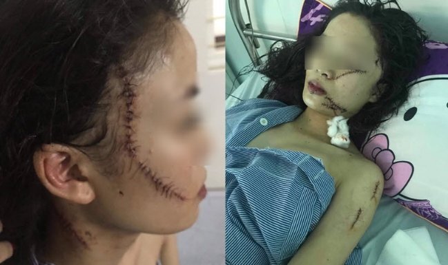 Toàn cảnh thiếu nữ 18 tuổi bị 3 cô gái đánh đập, rạch mặt giữa đêm