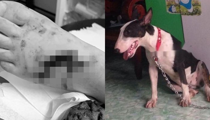 Bé trai 6 tuổi gãy chân, nhập viện khẩn cấp do bị chó nhà hàng xóm cắn