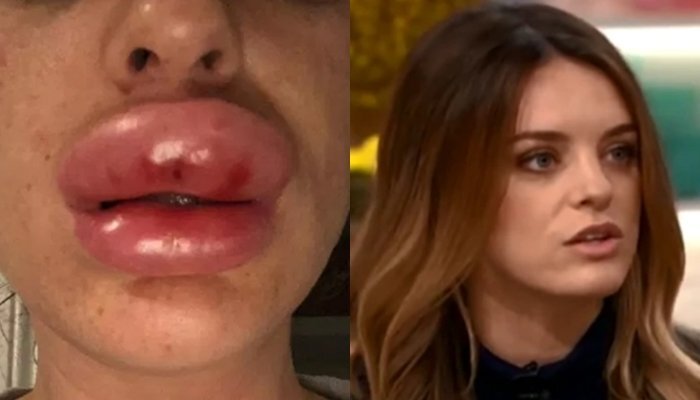 Tiêm botox tại nhà, đôi môi của cô gái trẻ sưng gấp 4 lần bình thường