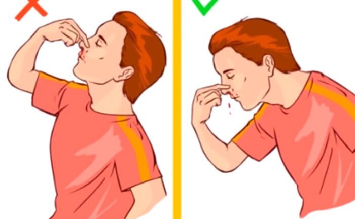 Video: Những sai lầm khi sơ cứu khiến bệnh nhẹ thành nặng