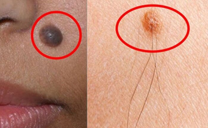 Có phải cứ nốt ruồi mọc lông là bị ung thư?