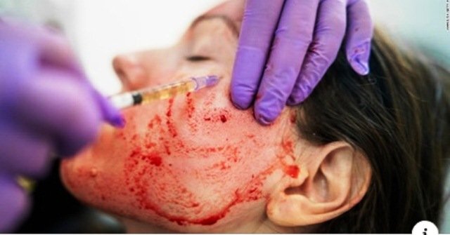 Chuyên gia chỉ rõ lý do bị lây nhiễm HIV từ lăn kim, dùng huyết tương khi làm đẹp