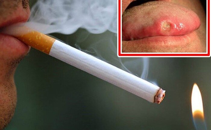 Cô gái 23 tuổi phải cắt bỏ 1/2 lưỡi, bác sĩ cảnh báo người trẻ đang mắc căn bệnh đáng sợ