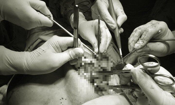 Lấy cả đống máu cục trong ngực nữ doanh nhân sau khi thẩm mỹ ở nước ngoài