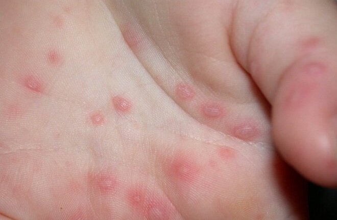 250 bé sơ sinh Thái Lan mắc bệnh giang mai