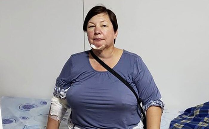 Chi 100 triệu hút mỡ, người phụ nữ chịu đau đớn khi da bụng bị hoại tử