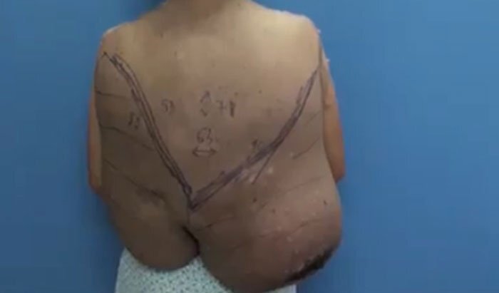 Cứu người phụ nữ 'cõng' khối u khổng lồ 12kg