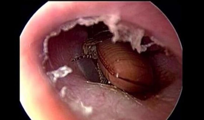 Clip: Rùng mình cảnh bác sĩ đuổi gián ra khỏi tai bệnh nhân