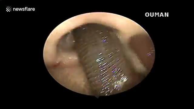 Clip: Gắp đỉa dài 10 cm sống ngoe nguẩy ra khỏi mũi người phụ nữ ở Nghệ An