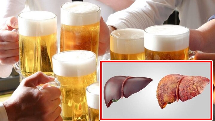 Những tổn thương gan phải 'gánh' nếu sử dụng quá nhiều bia rượu