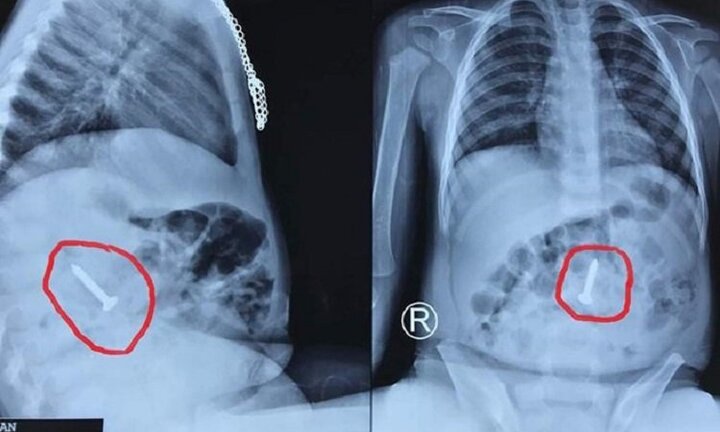 Đinh vít 3,5 cm trong bụng bé 20 tháng tuổi