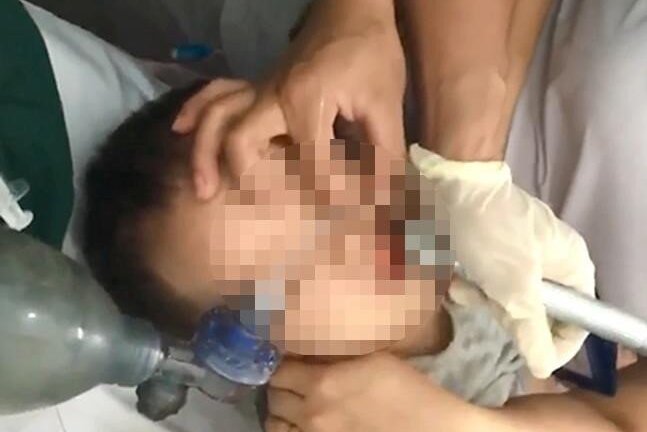 Hóc thạch rau câu, bé 2 tuổi tại Nghệ An suýt chết